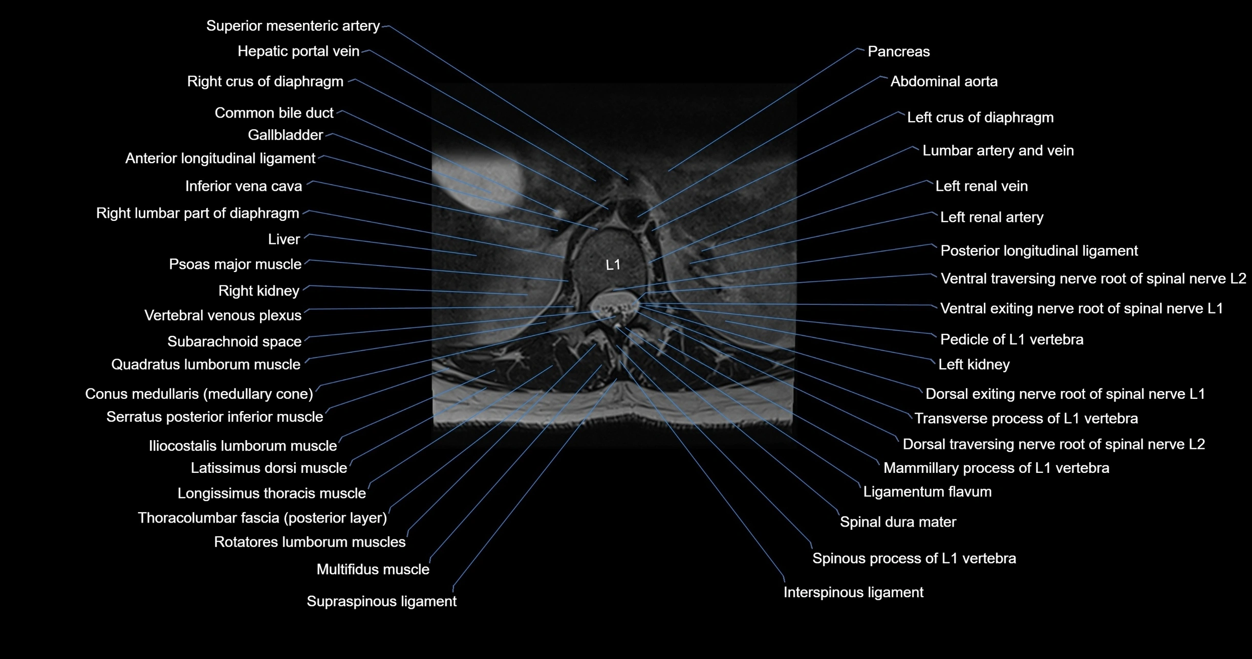 MRI lumbar spine axial cross sectional anatomy 3T radiology  image-img-00001-00008.webp